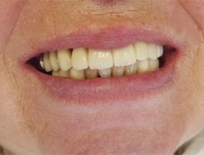 Современная имплантология в Германии. «Зубы за 1 день» 